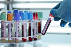 Создан новый анализ крови для оценки риска инсульта